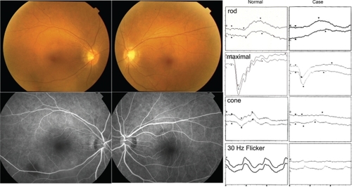 Figure 1 Fundus photograph and fluorescein angiography appears normal (left panels). Electroretinogram shows marked loss of cone function in both eyes (right panels).