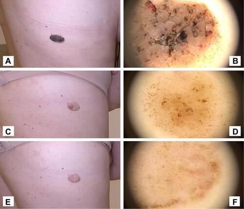 Figure 7 Case 1. (A and B) Macro-photo and dermoscope pictures of a large and thick seborrheic keratosis before HIFU. (C and D) Macro-photo and dermoscope pictures 6 weeks after initial HIFU treatment. The seborrheic keratosis has clearly reduced in thickness and the majority of brown clods and coiled vessels have been removed. The lesion is however still clearly visible, in particular in the periphery of the original lesion. A second repeat treatment was administered. (E and F) Macro-photo and dermoscope picture at follow-up visit 10 weeks after first treatment (4 weeks after second treatment). The visual appearance is significantly improved, but seborrheic keratosis is still visible, and a third treatment will be needed to fully remove the lesion.