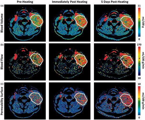 Figure 1. Temporal changes in vascular function following an increase in core body temperature in a patient with SCCHN (outlined in white). The panel of images represent parametric (a) blood volume (BV), (b) blood flow (BF) and (c) permeability surface (PS) maps calculated from perfusion CT scans at pre-heating (left), immediately post-heating (middle) and 5 days post-heating (right). Colour scale illustrates the increase in tumour BV, BF, and PS post-heat treatment.