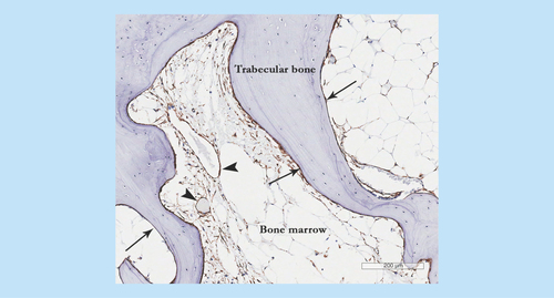 Figure 3.  Mesenchymal stem cell appearance in osteoarthritis subchondral bone showing CD271+ staining in perivascular (arrow heads) and bone lining (arrows) locations particularly in the areas of newly-formed bone.