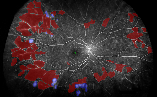 Figure 2 Example manual segmentation image of biomarkers. UWF FA of patient with PDR and manual segmentation completed. Green represents FAZ, red represents areas of nonperfusion, and purple represents areas of neovascularization. Following segmentation, biomarker areas were calculated.