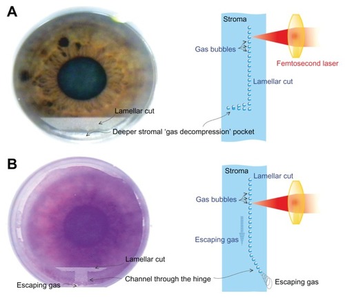 Figure 6 Schematic of the architectural differences between the (A) Intralase™ FS60 (Abbott Medical Optics, Santa Ana, CA, USA) and (B) WaveLight® FS200 (Alcon, Fort Worth, TX, USA) femtosecond lasers.