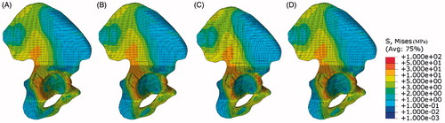Figure 6. The stress distribution in the iliac bone under different femur rotation angles with no fixation systems under 1200N static vertical loads. (A) 0°, (B) 5°, (C) 10°, (D) 15°.