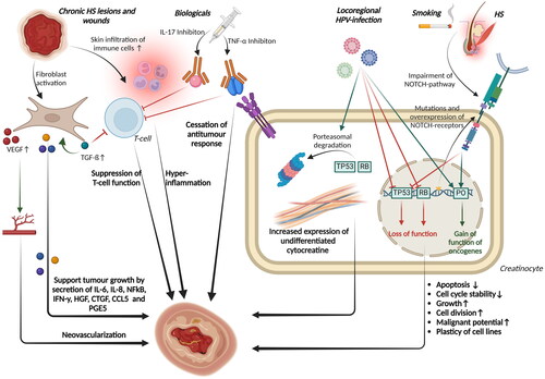 Figure 3. Shows an overview of possible pathomechanisms of malignant transformation of chronic Hidradenitis suppurativa (HS) into cutaneous squamous cell carcinoma or marjolin ulcer. Genetic alterations in Hidradenitis suppurativa (HS) and comorbid smoking lead to impairment of the NOTCH signaling pathway, which activates the expression of proto-oncogenes (POs) and suppresses that of the tumour suppressor gene 53 (TP53). Locoregional infections with high-risk human papillomaviruses (HPV) support the genetic effects of malignant development. Increased expression of undifferentiated cytocreatins can be observed in creatinocytes. Treatment with biologics can impair the anti-tumour response of T cells and other body cells. Chronic wounds can promote degeneration through recruitment and activation of fibroblasts, deposition of extracellular matrix components, infiltration of immune cells and hyperinflammation, neovascularisation and cell lineage plasticity. RB, Retinoblastom-Protein; HGF, hepatocyte growth factor; CTGF, connective growth factor.