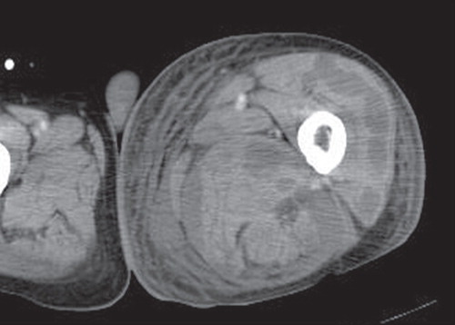 Figure 3. Computed tomography of the left thigh of case 2. A circumferential abscess pattern was observed.