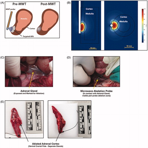 Figure 2. (A) Schema for delivering microwave thermal therapy (MWT) to a benign adenoma in the adrenal target. Micro-wave power is delivered with a side-firing applicator positioned adjacent to the cortex. (B) Temperature profile and estimate of the ablation zone extent for the side-firing ablation probe. (C) Under open surgery in a porcine model, the adrenal gland was exposed by displacing the bowel. (D) The 2.45 GHz side-firing microwave applicator was positioned adjacent to the adrenal gland by direct visualization, and power delivered for 60 s to the cranial pole. (E) Adrenal glands were excised 48 h post-ablation; the region where thermal damage was delivered was identified by visible tissue discoloration, and sections were taken for histopathologic analysis.