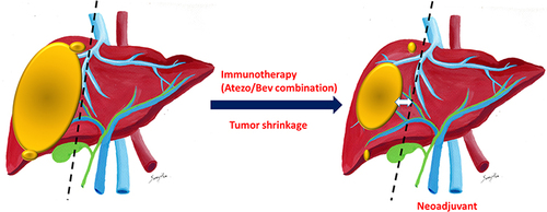 Figure 4 Neoadjuvant therapy with ICI or Atezo/Bev combination.