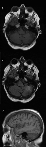 Figure 2. Follow-up MRI brain at 1 year showing evidence of prior resection of the left cerebellar mass with no recurrence of metastatic lesion or new metastasis.