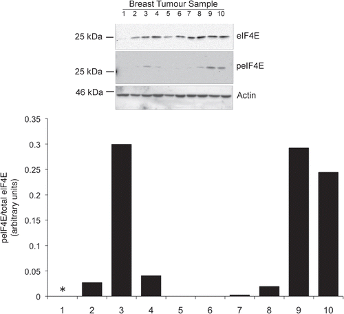 Figure 1 eIF4E expression and phosphorylation in breast cancer tissue. Equal protein concentrations from 10 breast cancer tissue samples were separated by SDS-PAGE and western blots probed with antibodies to eIF4E and serine 209 phosphorylated eIF4E. Figure representative of two independent blots. Quantitation shows the relative ratios of phosphorylated- to total eIF4E between the samples (*indicates total eIF4E is too low for a reliable analysis).