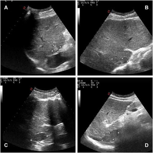 Figure 1 The abdominal ultrasonography revealed an isoechoic mass (3.5cm×1.0 cm in size) in the posterior right lobe (A and B), and a hypoechoic strip-like area measuring 3.7 cm × 1.9 cm was noted in the retrohepatic segment of the inferior vena cava (tumor thrombosis suspected, (C and D).