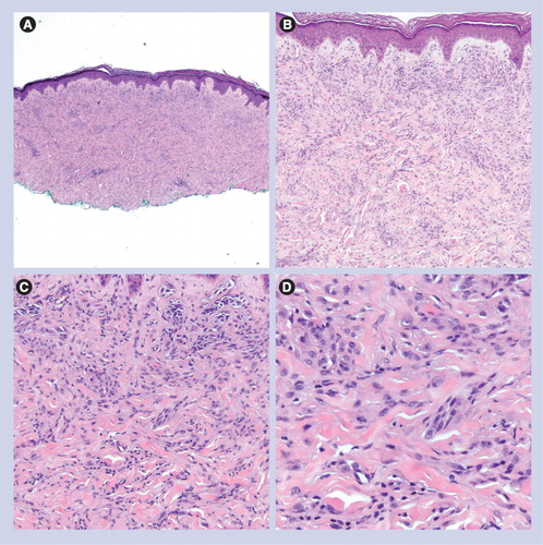 Figure 3. Desmoplastic Spitz nevus.(A) Dermal-based lesion (40×). (B & C) Spindled and epithelioid melanocytes are arranged as fascicles or single units between sclerotic collagen bundles (100× and 200×, respectively). (D) Sclerotic collagen and epithelioid/spindled melanocytes (400×).