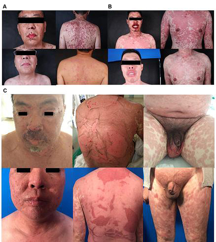 Figure 1 Photos before and after treatment: (A) (SJS), (B) (SJS/TEN overlapping), (C) (TEN).