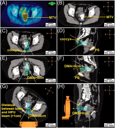 Figure 2. Representative image processing. (A) PET-CT in the axial view with the green contour indicating the location of MTV. (B) Corresponding axial CT with MTV fused as highly weighted volume. (C&D) Axial (C) and sagittal (D) view of targeting posteriorly. The white line indicates the HIFU beam-path and green cone-shaped area indicates the heating volume; the coccyx highlighted in yellow dashed line blocked the HIFU beam-path. (E&F) Axial (E) and sagittal (F) view of targeting anteriorly. The depth of the MTV represented by the yellow dashed line is longer than 8 cm; the PS highlighted by the yellow dashed contour blocked the HIFU beam-path. (G&H) Axial (G) and sagittal (H) views of the CT images rotated clockwise for 30°. The depth of the MTV represented by the yellow dashed line is less than 8 cm, and the distance between the bone and HIFU beam-path is longer than 1 cm.
