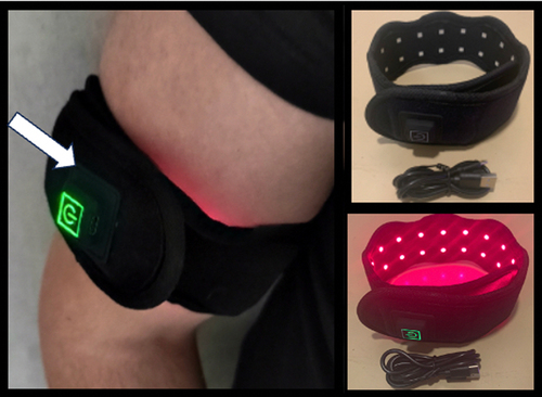Figure 4. Photobiomodulation Therapy (Nov – December 2023). A LED light wrap emitting infrared light (see methods) was placed around the arm as indicated and illuminated for 5 minutes exposure per day. Light wavelength was 730nm and intensity at the skin surface at 100w/m2. The patient reported relief from milder EHS symptoms caused by weather conditions (thunderstorms, strong winds) but not to more severe EHS elicitors (telecommunication, Wifi).