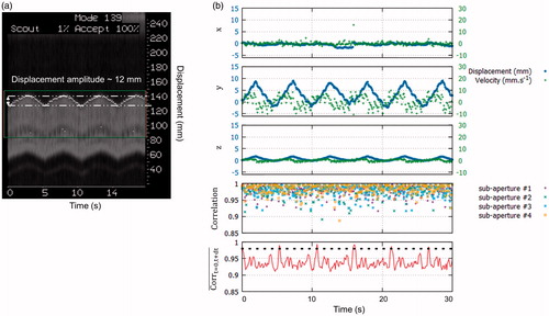 Figure 6. Displacement estimation in vivo in pig liver. (a) MR-navigator signal positioned along the y-axis acquired during 30 s. (b) Representative displacement estimations in (x→,y→,z→) obtained during in vivo experiment on liver. The blue and green curves represent the displacement estimations and the corresponding instantaneous speed computed from estimated positions, respectively. The bottom graph displays the normalised cross-correlations between two successive US acquisitions along time, for each sub-apertures. The red curve displays the mean correlation between current and the first acquisition taken as reference. The black dashed line represents the threshold above which absolute displacement estimations is performed to reset the position. (Colored version is available on the journal’s webpage).