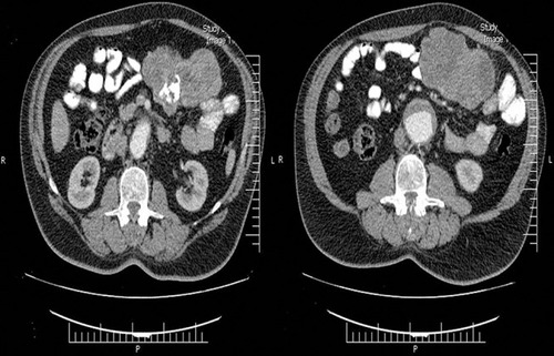 Figure 1 (A, B) Computed tomography scan depicted perijejunal mass sized 141*85 mm with central necrosis and calcification.