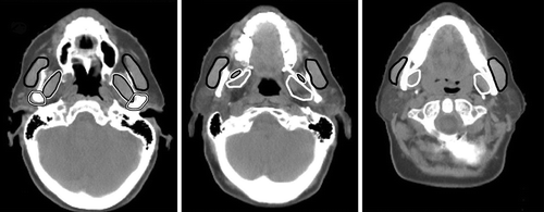 Figure 1. Delineated structures important for mastication in three different CT slices: masseter (black line), lateral (black line with white outline), and medial (white line) pterygoid muscles, and temporomandibular joints (white line with black outlines).