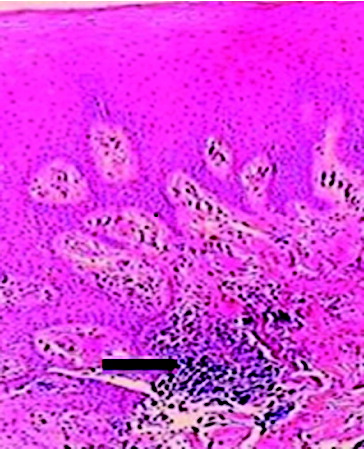 Figure 3. Severe infiltration of inflammatory cells in the connective tissue area (arrow).
