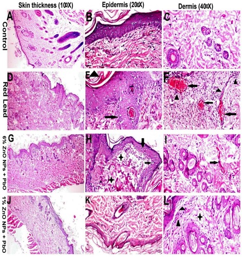 Figure 2 Histopathological alterations in the skin tissue sections of rats in different groups. (A-C) Skin of rats in control groups showing normal epidermal and dermal layers. (D-F) Skin of rats treated with PbO showing, (D) increasing skin layer thickness, (E) epidermal hyperplasia (arrow), vacuolar degenerations, and hyperkeratosis (arrowhead), (F) Severe dermal congestion (arrow), edema and inflammatory cells infiltration especially around blood vessels (arrowhead). (G-I) Skin of rats treated with both PbO and 6% ZnO NPs showing, (G) Normal skin thickness, (H) Epidermal vacuolar degeneration (arrow) with dermal edema (star), (I) Moderate dermal edema with mild congestion (arrow). (J-L) Skin of rats treated with both PbO and 1% ZnO NPs showing, (J) normal skin thickness, (K) normal epidermal and dermal histology, (L) mild dermal edema (star) with minimum inflammatory cells infiltrations (arrow) (H&E staining for all figs).