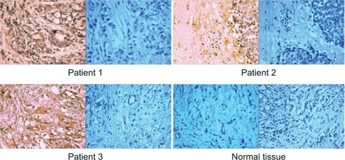 Figure 1 Imunohistochemical staining of pancreatic cancers (×20) from three patients with positive staining of tumors with GluN2B antibodies (left panels) and negative controls of GluN2B antibodies in the presence of excess peptide antigen (right panels).