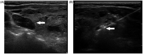 Figure 1. The parathyroid nodule presents a hypoechoic signal before MWA (A). The ablation needle was inserted into the parathyroid tissue under ultrasound guidance (B).