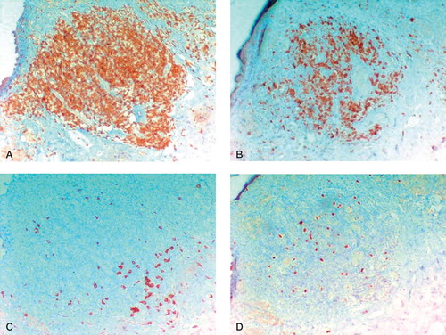 Figure 6. Different immunohistological stainings for a prominent synovial perivascular lymphatic follicle (magnification 100×). A. Follicular pattern of CD3-positive T-lymphocytes (brown-colored). B. Follicular pattern of CD20-positive B-lymphocytes. C. In the periphery, a small line of CD138-positive plasma cells. D. Increased number of MIB-1-positive lymphocytes showing proliferation.
