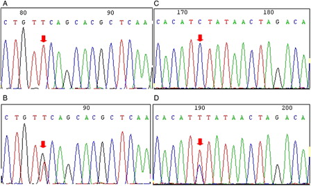 Figure 3. Polymorphism at positions 12486 (rs2230926) and 13749 (rs5029948) in the A20 gene. (A) Wild-type sequence at position 12486 (arrow) in the A20 gene in a T-ALL case. (B) Heterozygous polymorphism (T > G) at position 12486 (arrow) in the A20 gene in a T-ALL case. (C) Wild-type sequence at position 13749 in the A20 gene in a T-ALL case. (D) Heterozygous C > T nucleotide exchange at position 13749 in the A20 gene in Molt-4 cells.