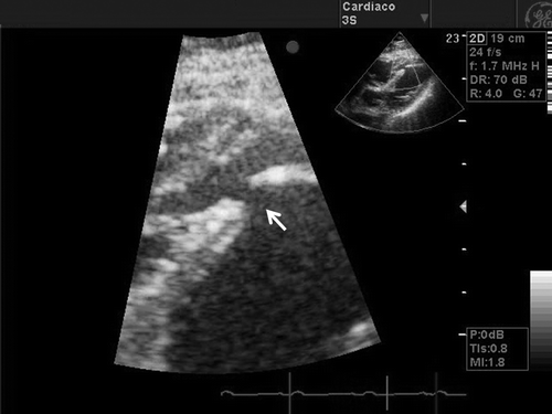 Figure 2.  Sub-costal view, on the transthoracic echocardiogram, showing apical ventricular septal defect (arrow in the zoom mode).