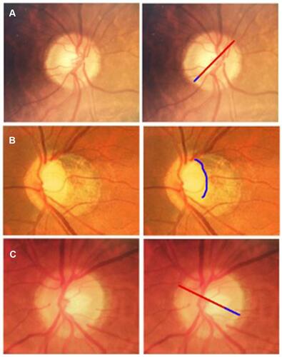 Figure 2 Examples of DDLS gradings for 3 eyes, with small (A) and large (B and C) optic disc diameters. For example (A), the thinnest width of the rim is approximately 1/7th (0.14), the diameter of the optic disc in the same Meridian, which for a small optic disc, is equivalent to a DDLS of 3. For example (B), there is no rim over approximately 130 degrees, which for a large optic disc, is equivalent to a DDLS of 6. Care however must be taken in myopic eyes, to differentiate temporal sloping of the rim from absence of rim tissue. For example, (C), the thinnest width of the rim is approximately ¼ the diameter of the optic disc, which for a large disc is equivalent to a DDLS of 0b.