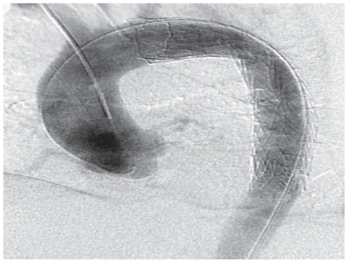 Figure 3 Successful deployment of a thoracic stent in the aortic arch and proximal descending thoracic aorta, sealing off the entry tear.
