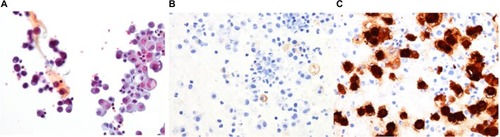 Figure 3 (A) Photomicrographs of thoracentesis sample at medium magnification from right pleural effusion shows the presence of a dual population of cells: mesothelial and malignant cells. The malignant cell population are highlighted with positive staining with BER-EP4 (B) and negative to calretinin, (C) which is expressed in the surrounding nonneoplastic mesothelial cells, supporting the presence of metastatic disease.