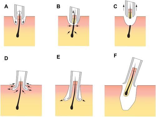 Figure 2 Patent application schematics demonstrating the advantage of a flared punch cutting tip. (A) Outer beveled punch tip shows cutting vectors directed towards the follicle; (B and C) the outer beveled punch transects the follicle before advancing to the follicle’s level (D) a flared punch with cutting vectors pointing away from the follicle (E and F) show minimal tendency to transect grafts while reaching deeper levels of the follicle, unlike the outer beveled punch.