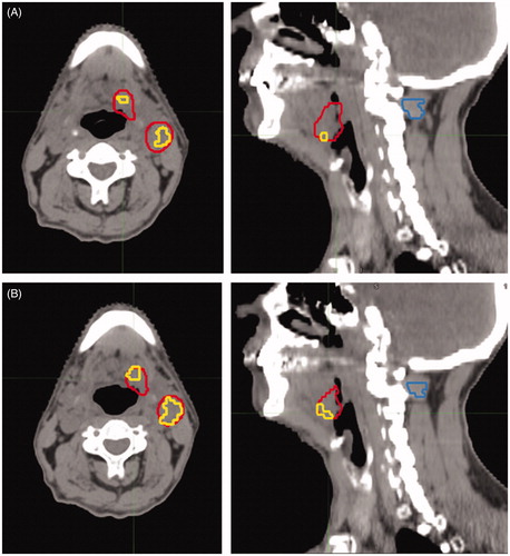 Figure 1. FAZA PET/CT of a patient with a T2N2b HPV/p16neg oropharyngeal cancer. The axial and sagittal slices of the attenuation CT of the FAZA PET are displayed with the gross tumor volume (GTV) in red. Inside the GTV, voxels above hypoxic threshold are contoured in yellow. On the sagittal slices, the delineated muscle reference is shown (blue contour). The hypoxic volume on the pre-treatment, baseline FAZA PET/CT in seen in (A) and after ∼20 Gy is given (B). The hypoxic volume has increased during treatment, but will be covered by the high dose, as the dose escalation is applied to the entire GTV in the DAHANCA 33 trial.