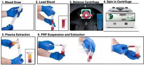 Figure 3 Representative pictures of 60mL L-PRP device processing: 1) a 18-gauge needle was attached to a 60mL syringe and 5–8mL of ACD-A was withdrawn. 2) The cap was unscrewed on center port of the L-PRP device and the green packaging post was discarded. Blood was slowly loaded into the center port. The syringe was removed and the tethered cap was attached to its port. 3) The L-PRP device was placed into the centrifuge and balanced with a counterbalance. 4) The L-PRP device was spun in centrifuge at 3200 RPM for 15 minutes. 5) The yellow cap was removed on the side port and a 30mL syringe was connected. The device was tilted at an angle, avoiding inverting to keep top blue vent dry, and all of the platelet-poor plasma (PPP) was removed. The yellow cap was replaced. 6) The red cap was removed on the side port and a 10mL syringe was connected. 2mL of PRP was withdrawn and syringe was left attached. With the 10mL syringe attached, the PRP was suspended by gently shaking L-PRP device for 30 seconds. The remaining PRP suspension was extracted into the attached 10mL syringe.