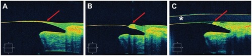 Figure 2 Cirrus HD-OCT images of the interface between the keratoprosthesis device and the carrier donor corneal tissue. (A) Epithelial tissue is visualized growing onto the anterior surface of the front plate (red arrow). (B) In the same patient, the epithelium was pushed back with a Merocel™ sponge at the slit-lamp and now appears as a scroll (red arrow). (C) The same patient after placement of a Kontur™ bandage contact lens (identified by an asterisk).