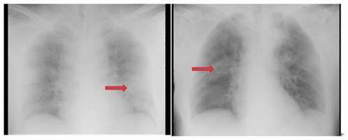 Figure 2. Typical change on chest radiographs of PT 10. The brightness of both lungs was decreased. Multiple patchy shadows with blurred edges were observed