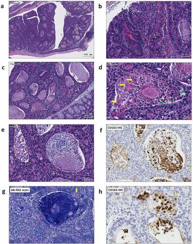 Figure 3. ST11 K. pneumoniae accelerated adenoma progression to high-grade dysplasia in AOM-DSS mice. (a) Representative images showing adenomas with high-grade dysplasia. The regions with histopathological features are framed and enlarged in B-H. (b) An adenoma region with full-thickness pseudostratification (red dash line), hemorrhage (green dash line), abnormal cells with enlarged and irregular nuclei (white arrow), infiltration of lymphocytes (red arrow) and neutrophils (blue arrow); (c) Cribriform (blue dash line) growth pattern of an adenoma; (d) A granuloma-like structure containing epithelioid macrophages (green arrow), giant cells (yellow arrow), and caseous necrosis (white dash line) in an adenomatous crypt; (e) Accumulation of foam cells (orange dash line), neutrophils (blue dash line), and macrophages (white dash line) in adenomatous crypts. CD163 immunostaining is shown in (f). Some of the macrophages with the red PAS positivity (g) were CD163+ (h) (yellow arrow)