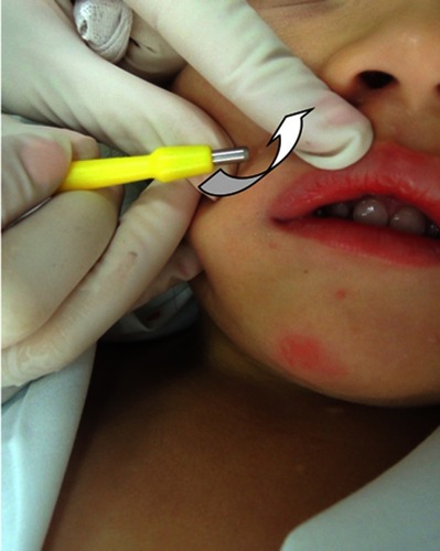 Figure 5 Mechanical removal (curettage) of a molluscum contagiosum with a punch tool. The punch should be positioned in <30° to the skin surface and a shear movement should be performed to remove the molluscum in its entirety.