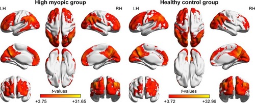 Figure 1 One-sample t-test results. Within-group ALFF maps within the HM (left) and HC (right) groups (P<0.001, FDR corrected).