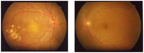 Figure 4 Fundus photograph after vitrectomy of the right eye. The retinal infiltrates and exudates have progressed in the right eye within one week since the previous examination. The left eye fundus had no abnormality.