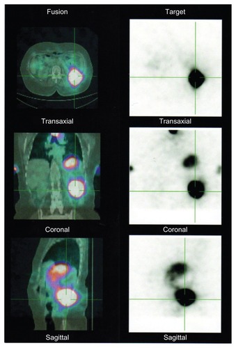 Figure 1 SPECT.