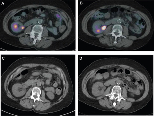 Figure 2. Patient 2. PET scans from (A) February 2010 showing a maximum SUV uptake value of 4.03 and (B) May 2010 with a maximum SUV uptake value of 2.51. CT scan from (C) February 2010 and (D) May 2010.