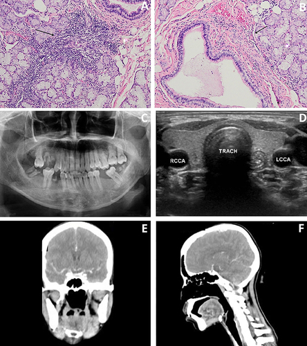 Figure 3 (A and B) Histopathological examination results: PMN inflammatory cells and lymphocyte inflammatory cells (indicated by a black arrow on (A), plasma cells, accompanied by proliferation and dilatation of blood vessels, salivary gland acini, and tubular ductile (with 100× magnification) (indicated by a black arrow on (B). (C) Panoramic radiograph: no abnormalities. (D) USG Thyroid: within normal range, lymph node enlargement as high as level IIb colli dextra (E and F) head CT-scan (with contrast): did not show bone destruction, mass, and intracranial lesion, lymph node enlargement as high as level IIb colli dextra.