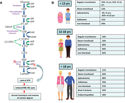 Figure 1 The physiopathology of pyruvate kinase deficiency (PKD), and its clinical features and complications. (A) The Embden-Meyerhof pathway alteration. (B) Different clinical features and complications during infancy, adolescence, and adulthood.