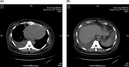Figure 1.  (A) Nonenhanced computerized tomography showing right-side pleural effusion and no pericardial effusion. (B) Nonenhanced computerized tomography showing moderate ascites in both the right perihepatic space and the left perisplenic space, slightly diminished size and slightly uneven surface of liver, periportal edema, and no splenomegaly.