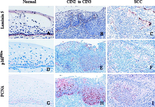 Figure 2.  Expression of laminin-5γ2 chain, p16INK4a and PCNA in samples from normal epithelium, different CIN stages, and invasive cervical cancer.