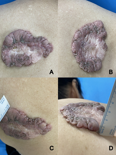 Figure 1 Lesion before treatment (A–C). Notice the thickness of the lesion is 1 cm (D).