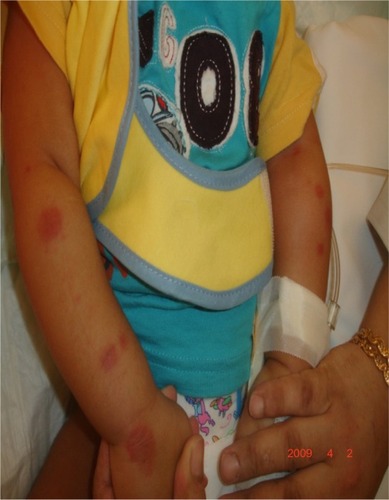 Figure 3 Circular and oval plagues on the upper extremities with swelling more prominent on the right side.