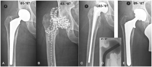 Figure 1. 2-stage revision. A. Infected hip prosthesis in a 68-year-old woman. After extraction of the prosthesis, implantation of 360 gentamicin-PMMA beads for 2 weeks (B), then exchange to a spacer for 2 months (C). D. Puncture for culture, after 2 weeks of “antibiotic holiday”. E. After re-admission, extraction of the spacer and reimplantation of a total hip.