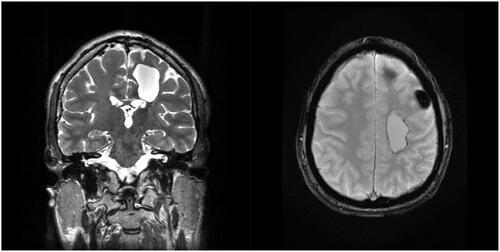 Figure 3. pre Rolandic brain metastasis in IRM, left lesion coronal section T2 (a) and axial section T2* (b).
